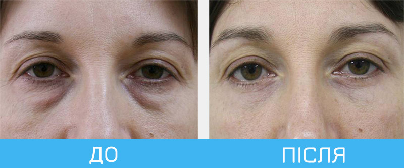 Блефаропластика